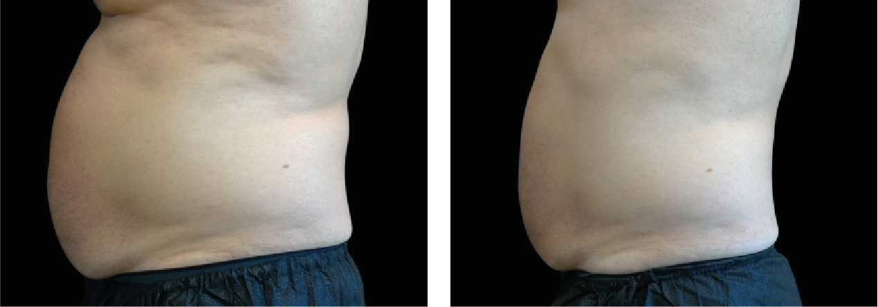 Abdomen 1