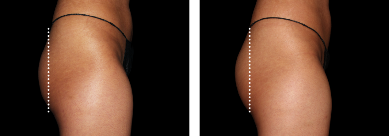 Buttocks